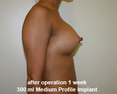 plastic-surgery-breast-augmentation